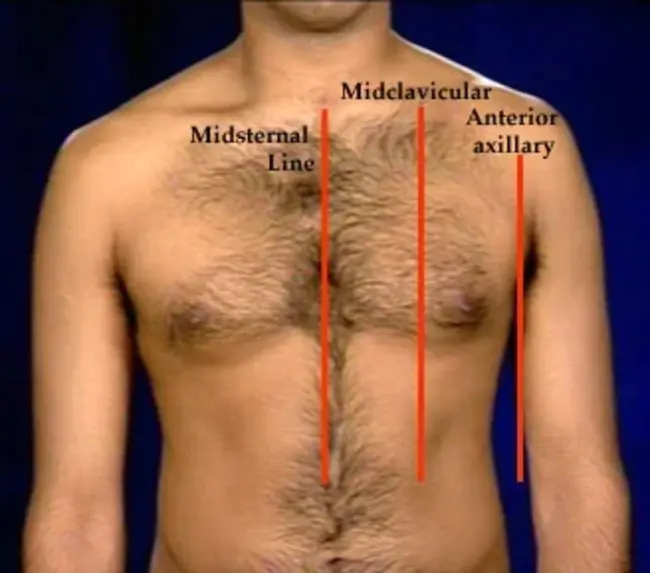 Midsternal Line : 胸骨中线