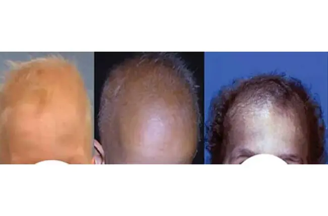 Cartilage-Hair Hypoplasia : 软骨毛发发育不全