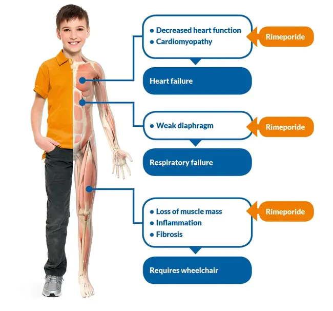 Duchenne Muscular Dystrophy : 杜氏肌营养不良症