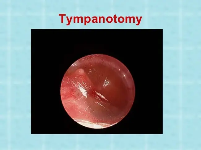 Tympanotomy Tubes : 鼓室切开管