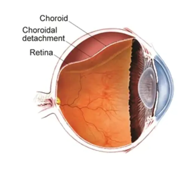 Choroidal NeoVascular membrane : 脉络膜新生血管膜