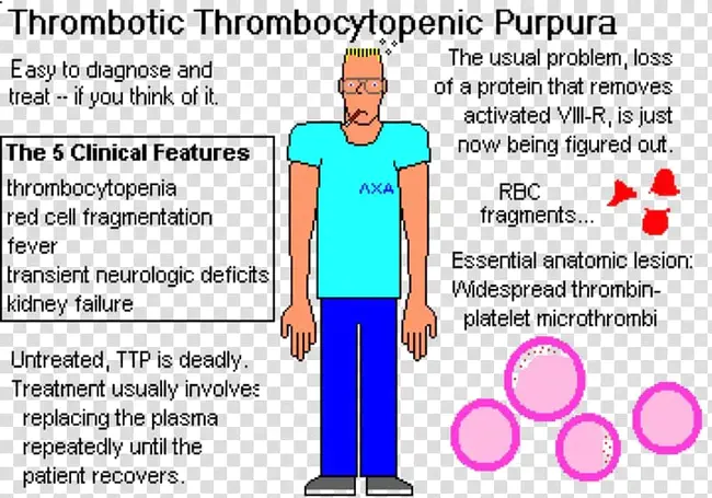 Thrombotic Thrombocytopenic Purpura : 血栓性血小板减少性紫癜