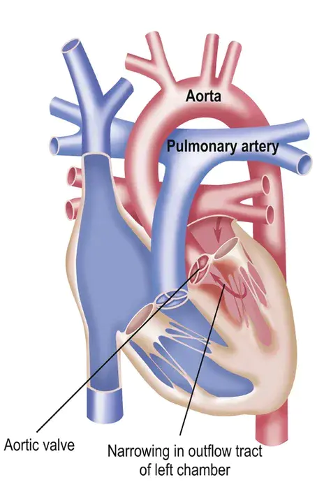 Subvalvular Aortic Stenosis : 主动脉瓣下狭窄