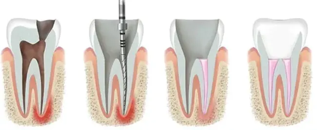 Root Canal Treatment : 根管治疗