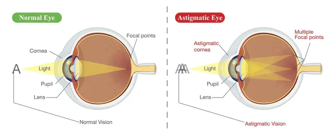 Astigmatic Keratotomy : 散光性角膜切除术