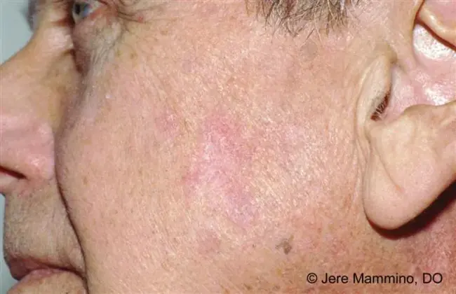 Actinic Keratosis : 光化性角化病