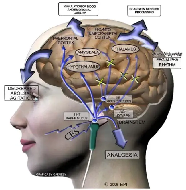 Cranial Electrical Stimulation : 颅脑电刺激