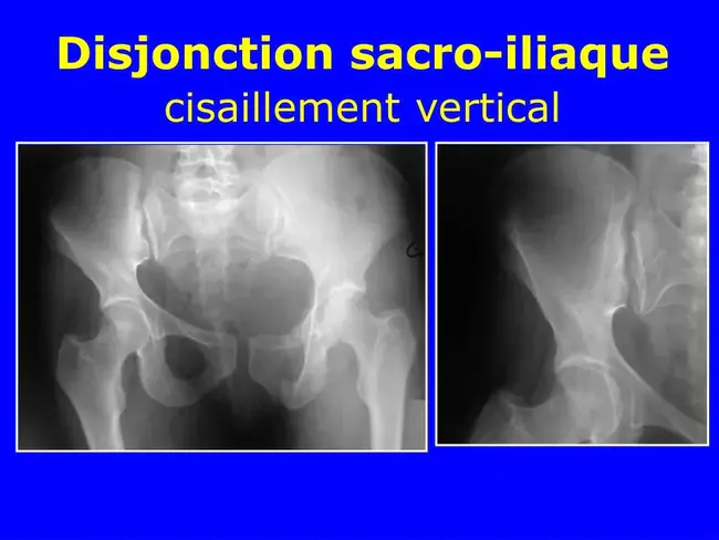 Sacro Occipital Technique : 骶枕技术