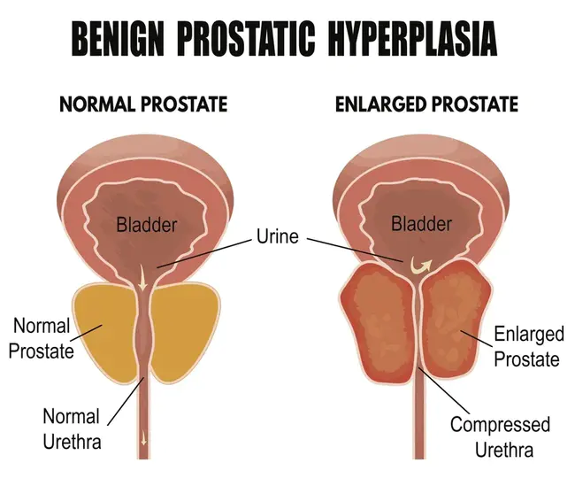 Prostate Cancer : 前列腺癌