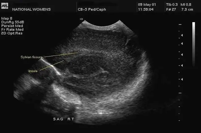 Cranial Ultrasound : 颅骨超声