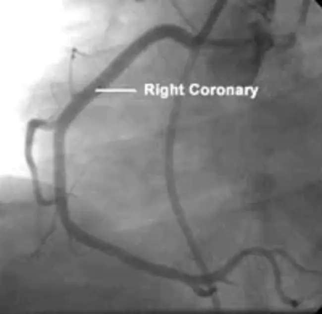 Right Coronary Artery : 右冠状动脉