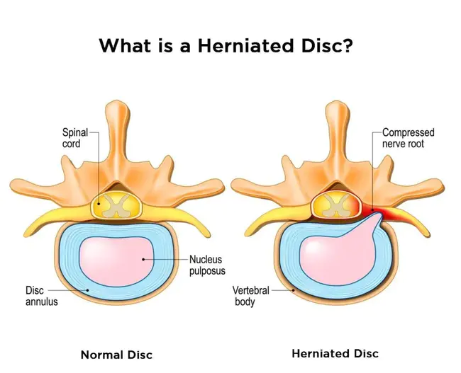 Herniated Nucleus Propulsus : 突出的推进核