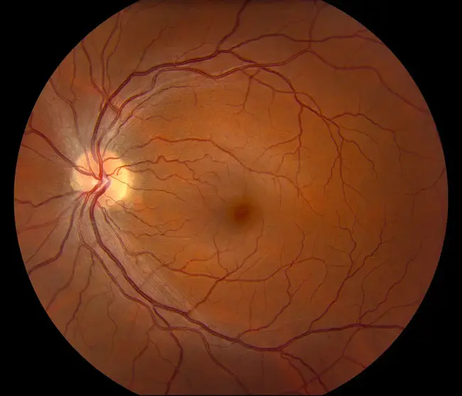 Retinopathy Of Prematurity : 早产儿视网膜病变