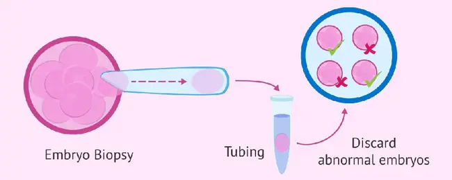 Preimplantation Genetic Diagnosis : 植入前遗传学诊断