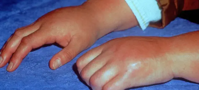 Reflex Sympathetic Dystrophy : 反射性交感神经营养不良