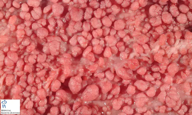 Adenomatous Polyposis Coli : 腺瘤性息肉病