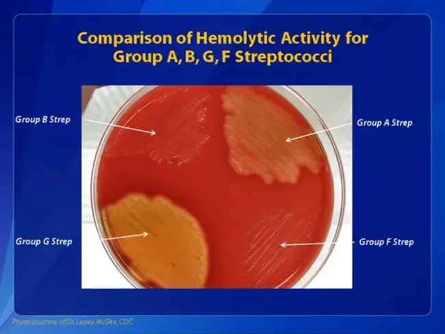 Hemolytic Uremic Syndrome : 溶血性尿毒症综合征