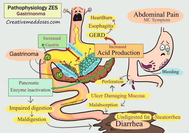 Zollinger- Ellison Syndrome : 佐林格-埃里森综合征