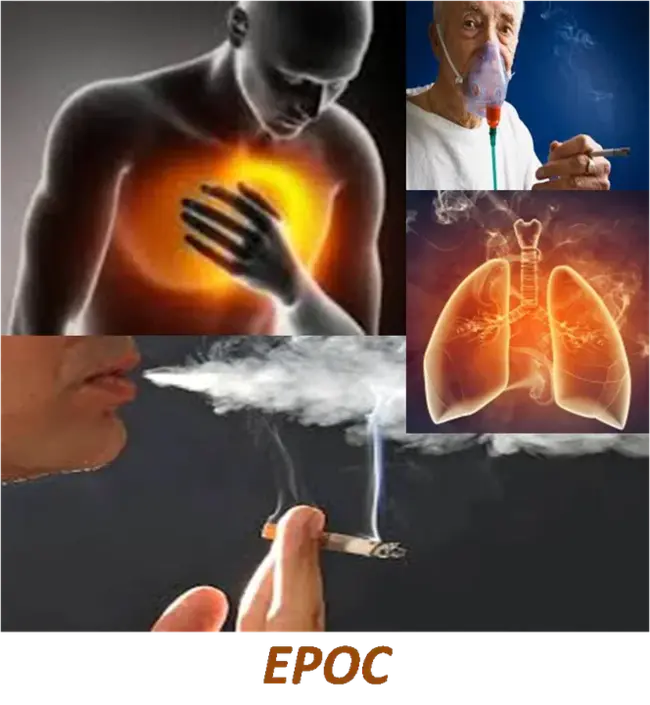 Epoc Release : EPOC释放