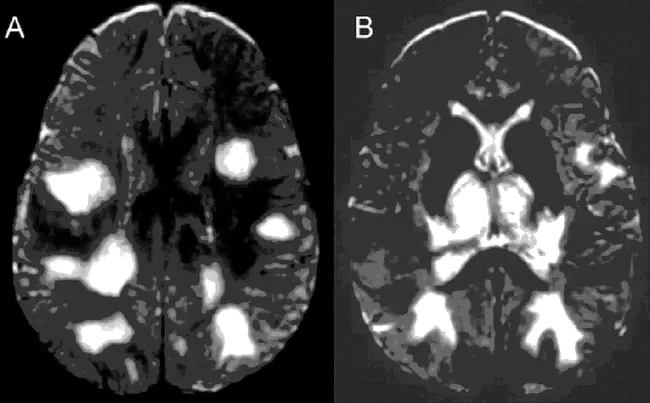 Disseminated Intravascular Coagulopathy : 弥漫性血管内凝血障碍