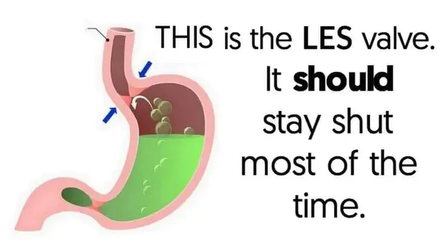 Chronic Reflux Disease : 慢性反流病