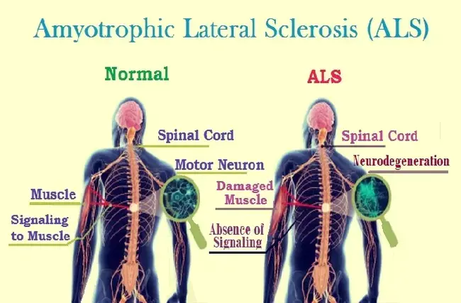 Amyotrophic Lateral Sclerosis : 肌萎缩侧索硬化