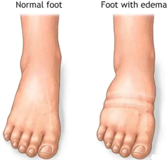 Edema Proteinuria And Hypertension : 水肿蛋白尿与高血压