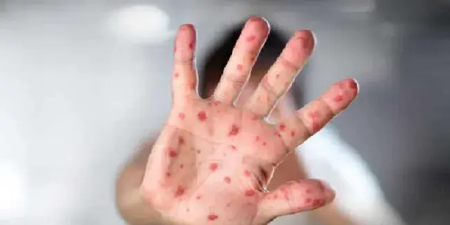 Measles, Mumps, Rubella shots : 麻疹、腮腺炎、风疹疫苗