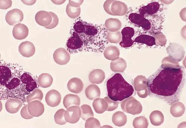 Eosinophilia Myalgia Syndrome : 嗜酸性肌痛综合征