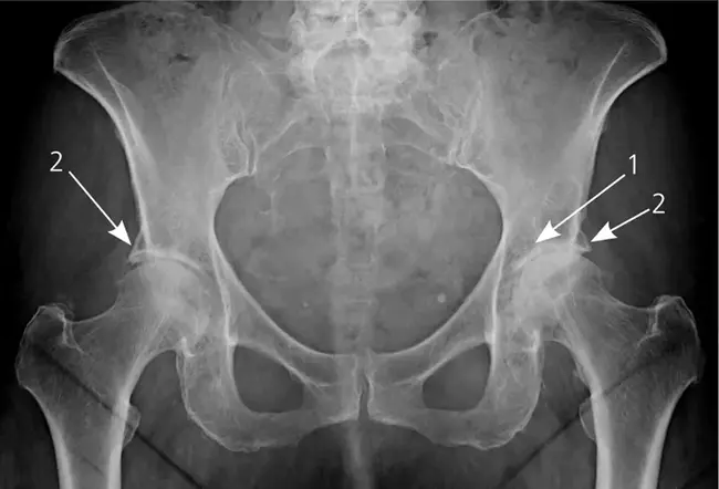 Hip Dysplasia : 髋关节发育不良