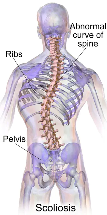 Scoliosis Research Society : 脊柱侧凸研究学会