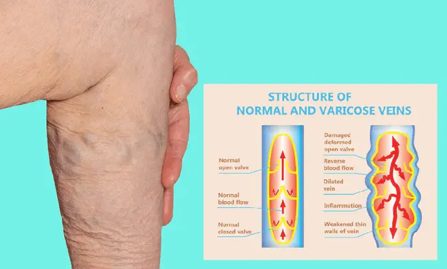 Superficial Vein Thrombosis : 浅静脉血栓形成