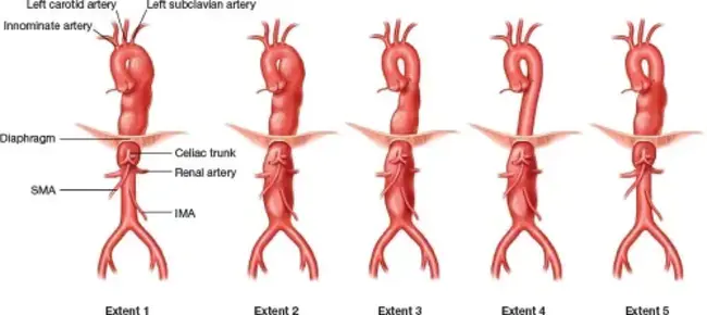 ThoracoAbdominal Aorta : 胸腹主动脉