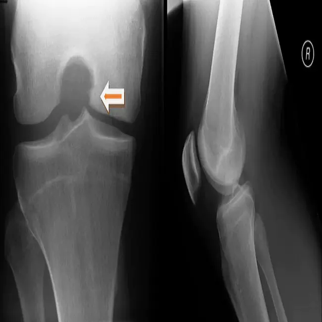 Osteochondral Autograft Transfer System : 骨软骨自体移植系统