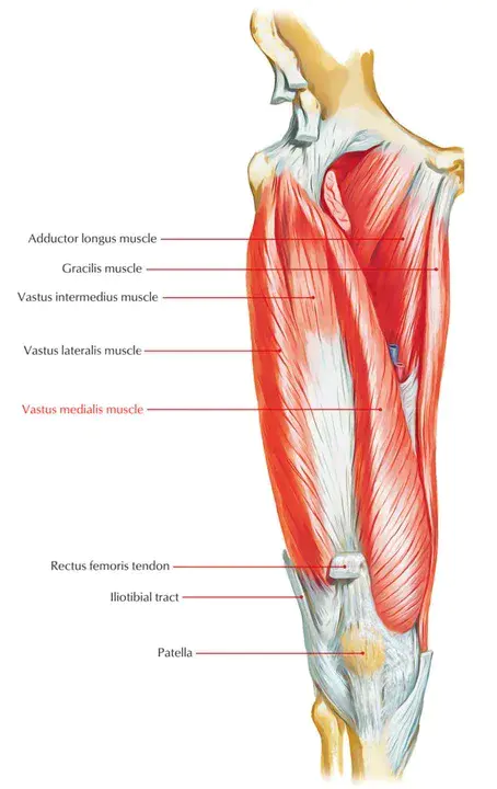 Vastus Medialis Obliques : 中隔肥大闭塞