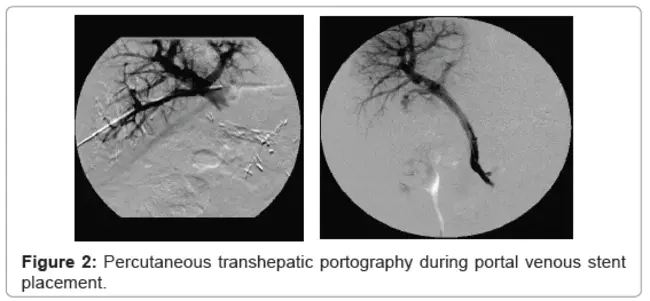 Transhepatic Intrajugular Portosystemic Shunt : 经肝颈静脉门系统分流术