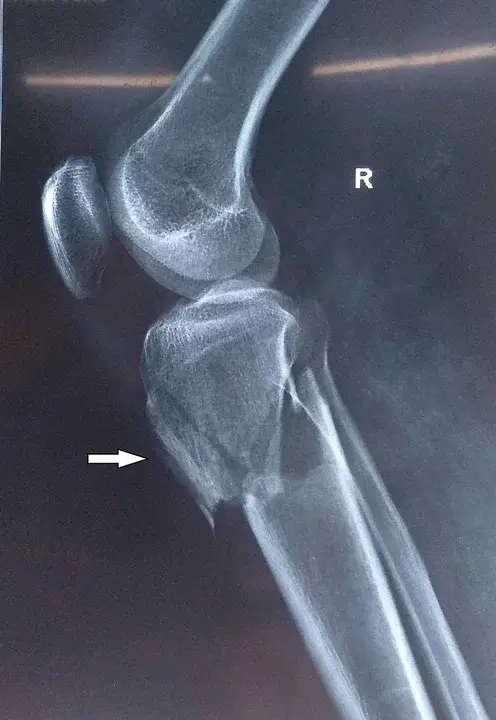 Tibial Tendon Transfer : 胫腱移植