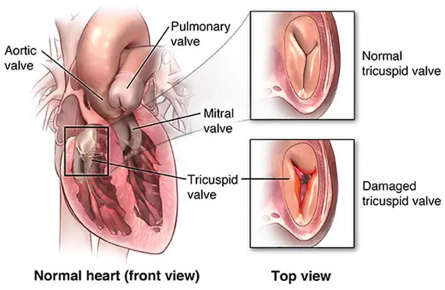 Tricuspid Stenosis : 三尖瓣狭窄