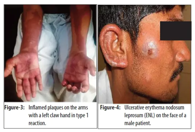 Benign Essential Blepharospasm : 良性原发性眼睑痉挛