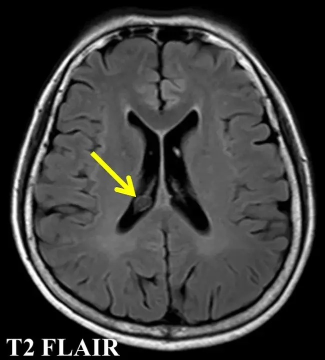 Choroid Plexus Cyst : 脉络丛囊肿