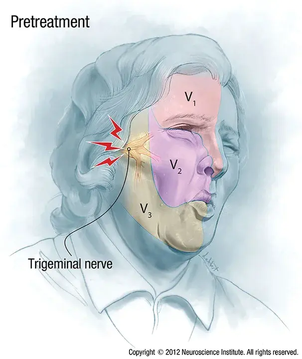 Neuralgia Inducing Cavitational Osteonecrosis : 神经痛引起空泡性骨坏死