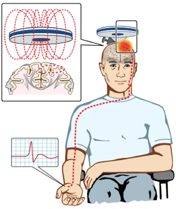 Transcranial Magnetic Stimulation : 经颅磁刺激