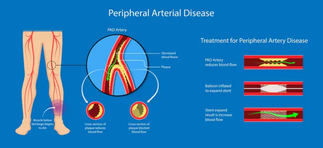 Peripheral Arterial Disease : 外周动脉疾病