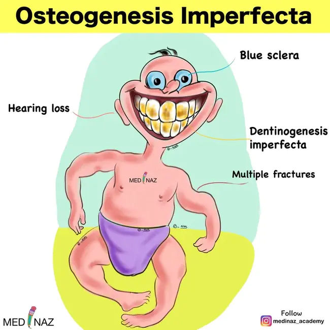 Osteogenesis Imperfecta : 成骨不全