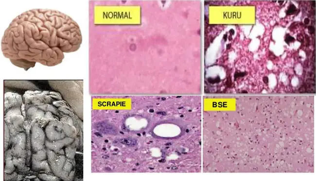 Transmissible Spongiform Encephalopathy : 传染性海绵状脑病