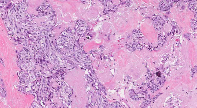 Medullary Thyroid Carcinoma : 甲状腺髓样癌