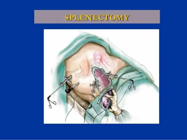 Laparoscopic Uterine Nerve Ablation : 腹腔镜子宫神经切除术