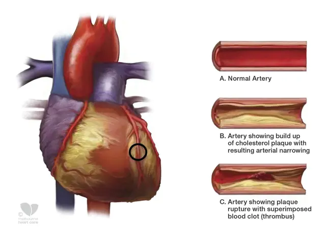 Atherosclerotic Calcification Eradication Study : 动脉粥样硬化钙化根除研究