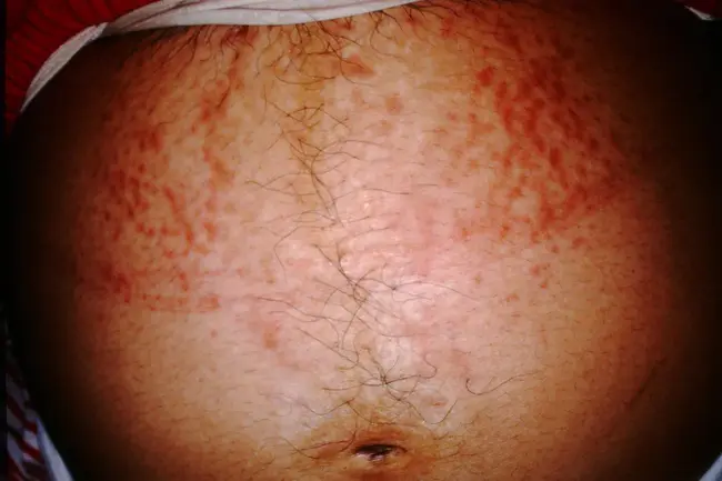 Pruritic Urticarial Papules And Plaques : 瘙痒性荨麻疹丘疹和斑块