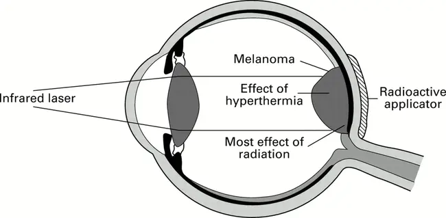 Transpupillary ThermoTheraphy : 经瞳孔热疗法